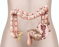 التهاب الرتوج (Diverticulitis): عندما تظهر تجاويف صغيرة في جدار القولون